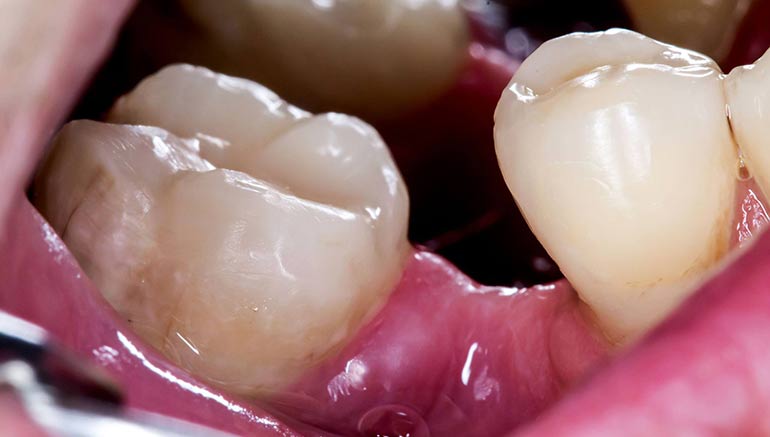 Miksi puuttuva hammas on korjattava mahdollisimman nopeasti? •  